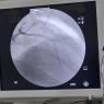 Angiograma coronario o cateterismo cardíaco