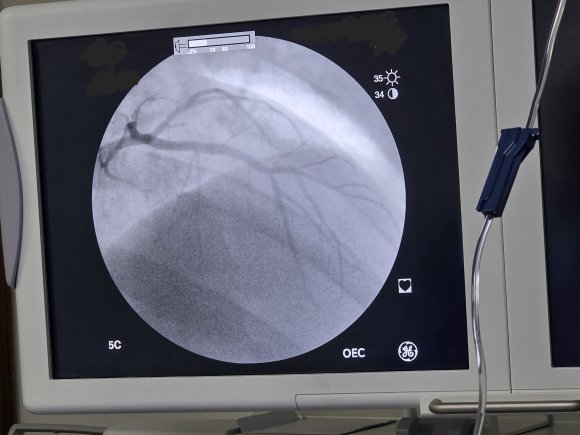 Angiograma coronario o cateterismo cardíaco