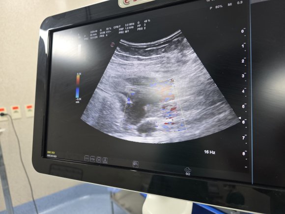 Imagen Ecografíca Absceso Abdominal