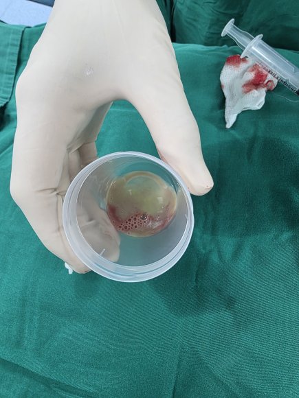 Muestra de Absceso abdominal 