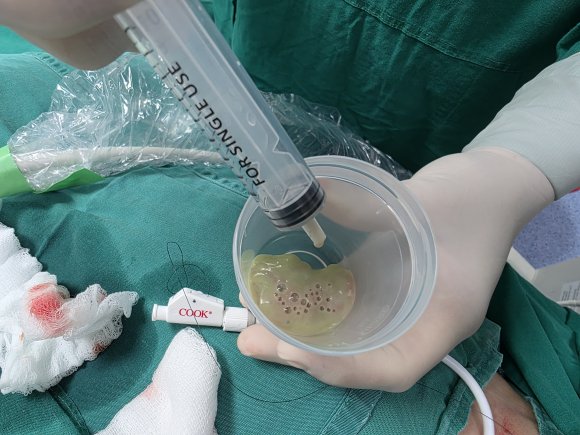 Absceso abdominal 